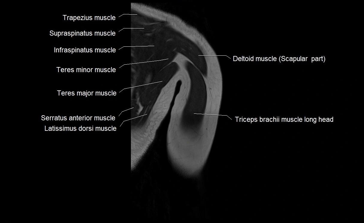 MRI upper arm (humerus ) coronal cross sectional anatomy image 27.webp